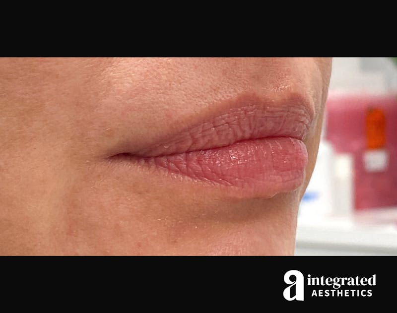 Lip Filler Before & After Gallery - Patient 157266202 - Image 3
