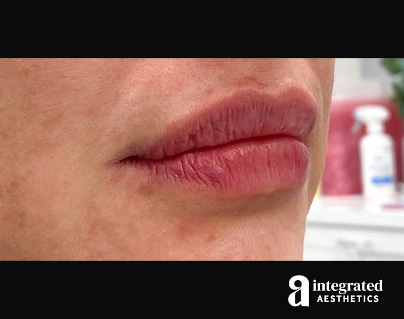 Lip Filler Before & After Gallery - Patient 157266202 - Image 4