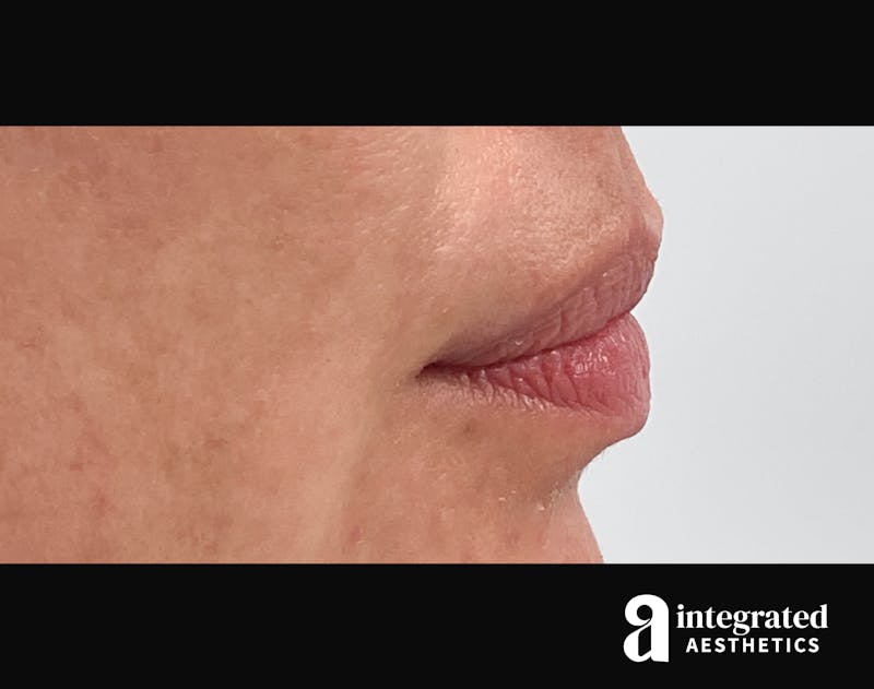Dermal Fillers Before & After Gallery - Patient 133212657 - Image 5