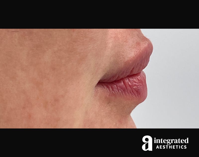 Lip Filler Before & After Gallery - Patient 157266202 - Image 6