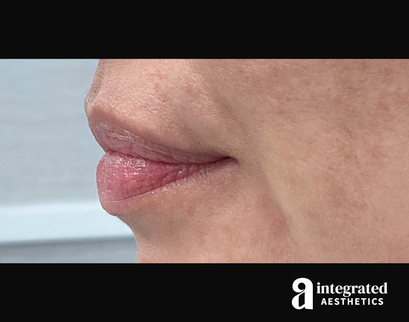 Lip Filler Before & After Gallery - Patient 157266202 - Image 7