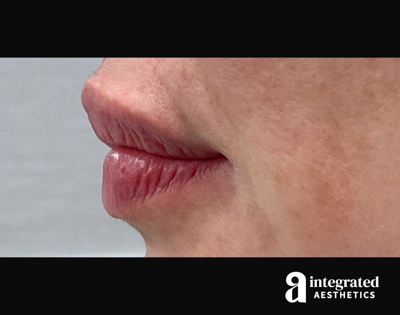 Lip Filler Before & After Gallery - Patient 157266202 - Image 8