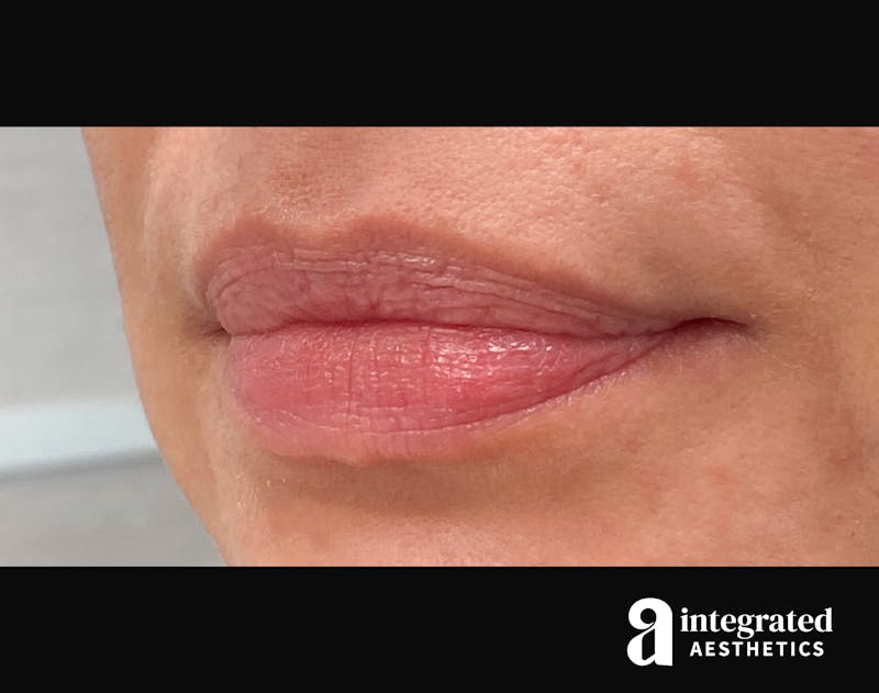 Lip Filler Before & After Gallery - Patient 157266202 - Image 9