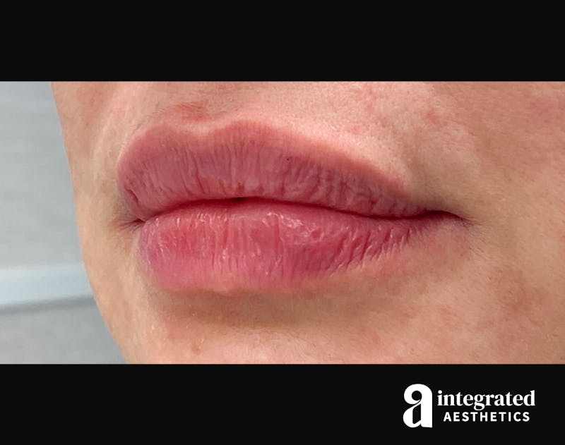Dermal Fillers Before & After Gallery - Patient 133212657 - Image 10