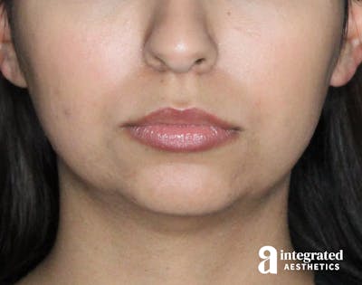 Dermal Fillers Before & After Gallery - Patient 133212666 - Image 1