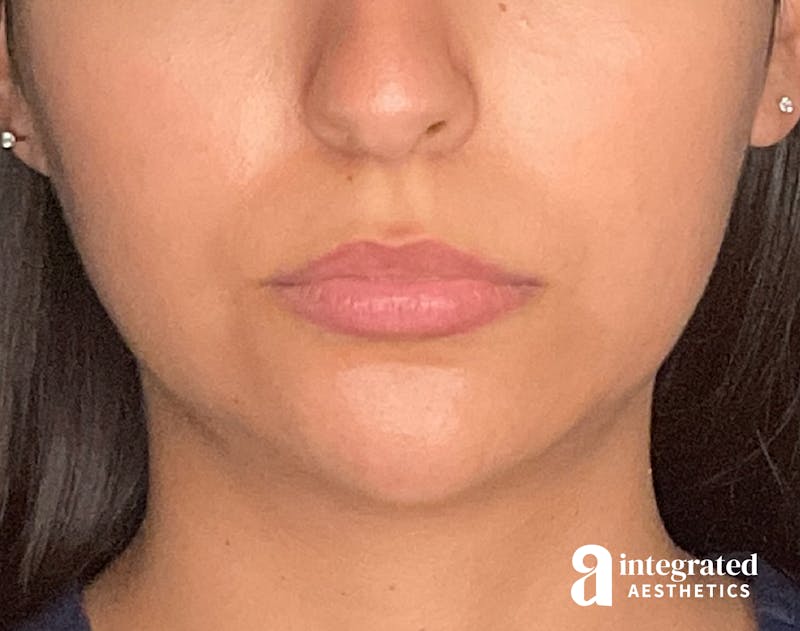 Dermal Fillers Before & After Gallery - Patient 133212666 - Image 2
