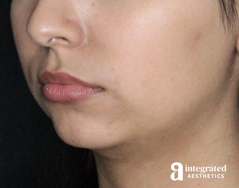 Dermal Fillers Before & After Gallery - Patient 133212666 - Image 3