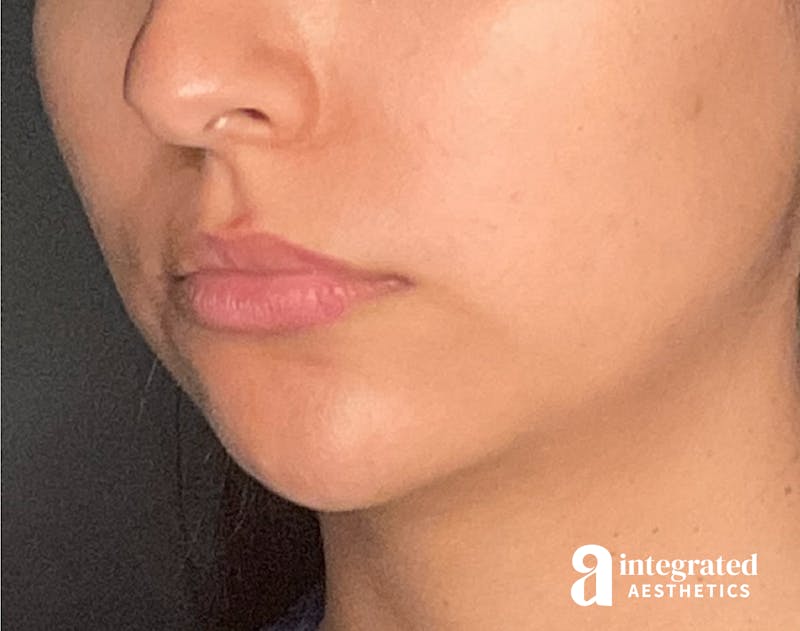 Dermal Fillers Before & After Gallery - Patient 133212666 - Image 4