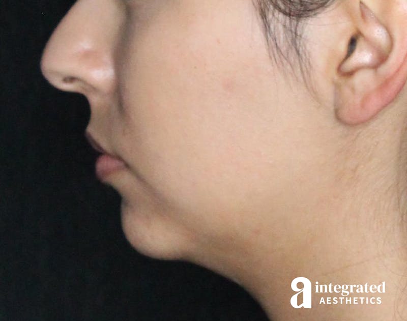 Dermal Fillers Before & After Gallery - Patient 133212666 - Image 7