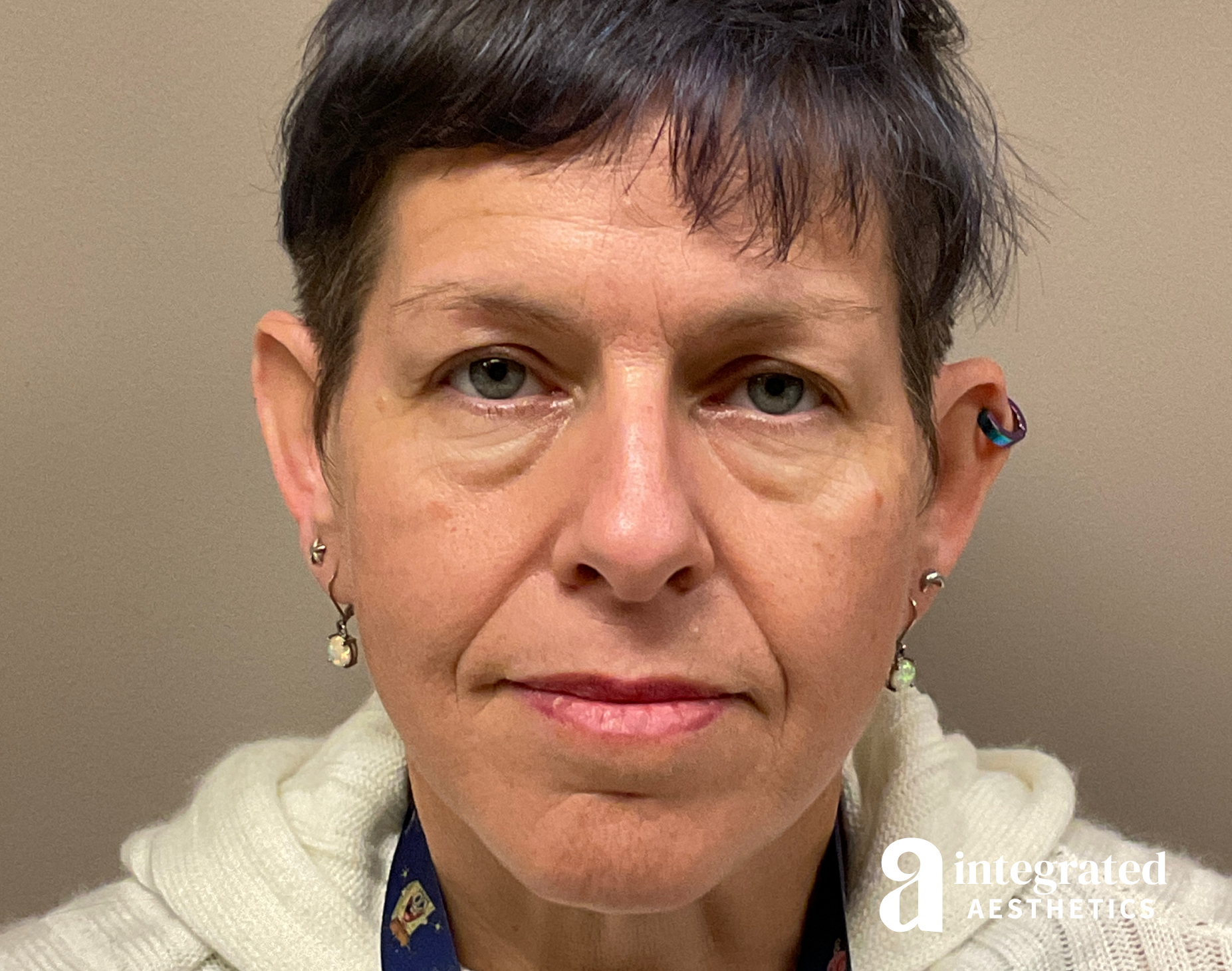 Patient 133212669 | Dermal Fillers Before &amp; After Photos | Integrated ...