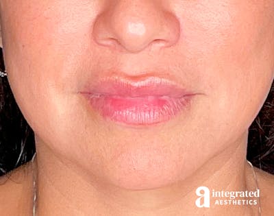 Dermal Fillers Before & After Gallery - Patient 133212668 - Image 1