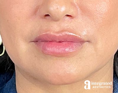 Dermal Fillers Before & After Gallery - Patient 133212668 - Image 2