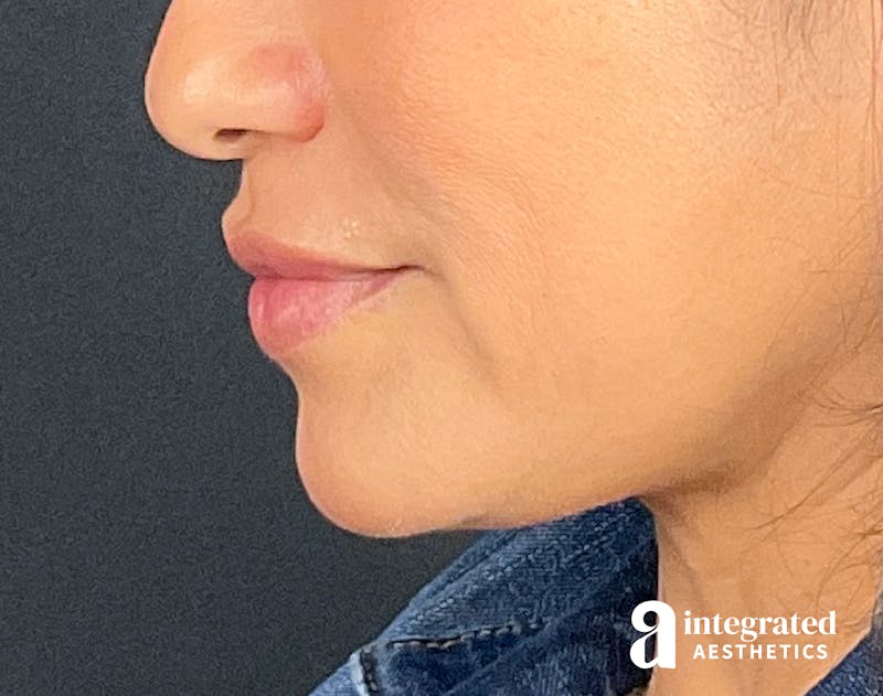 Dermal Fillers Before & After Gallery - Patient 133212668 - Image 6