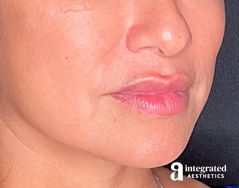 Dermal Fillers Before & After Gallery - Patient 133212668 - Image 7