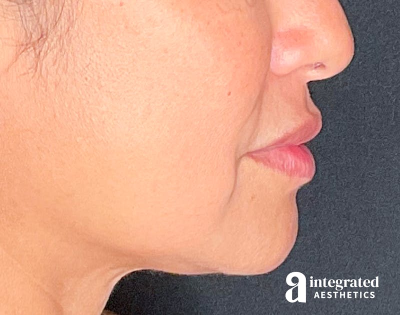 Dermal Fillers Before & After Gallery - Patient 133212668 - Image 9