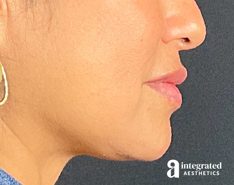 Dermal Fillers Before & After Gallery - Patient 133212668 - Image 10