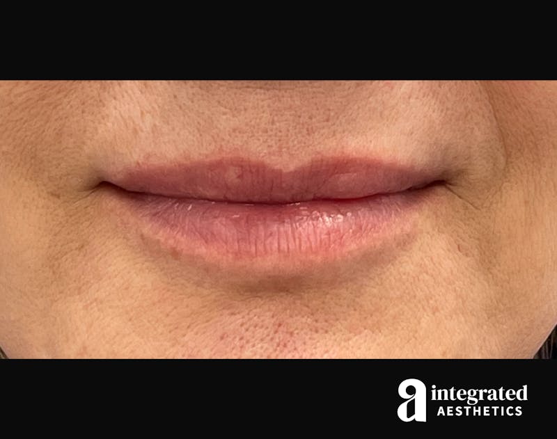 Dermal Fillers Before & After Gallery - Patient 133212672 - Image 1