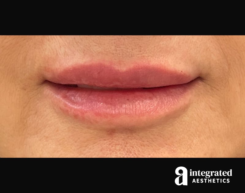 Dermal Fillers Before & After Gallery - Patient 133212672 - Image 2