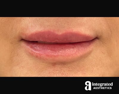 Dermal Fillers Before & After Gallery - Patient 133212672 - Image 2