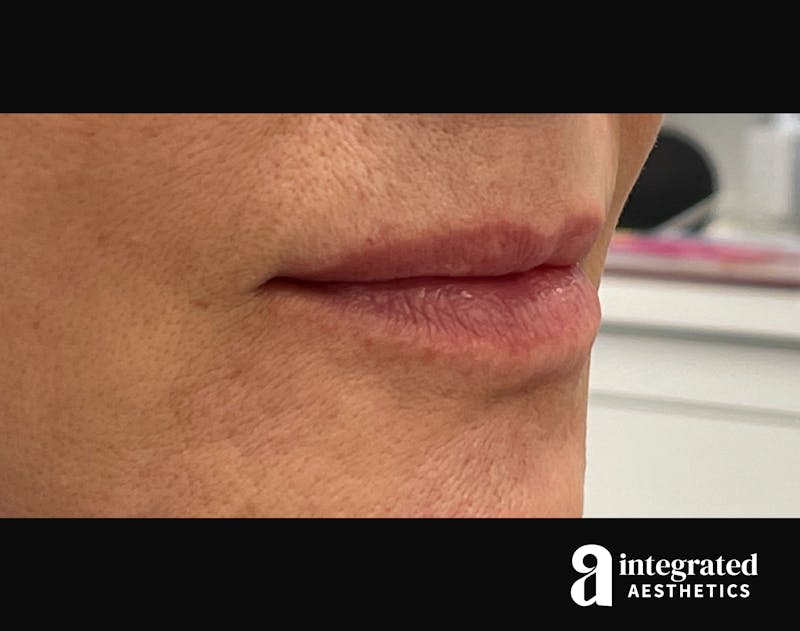 Dermal Fillers Before & After Gallery - Patient 133212672 - Image 3
