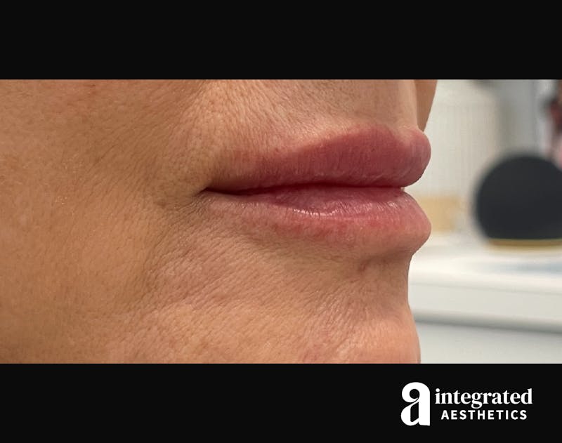 Dermal Fillers Before & After Gallery - Patient 133212672 - Image 4