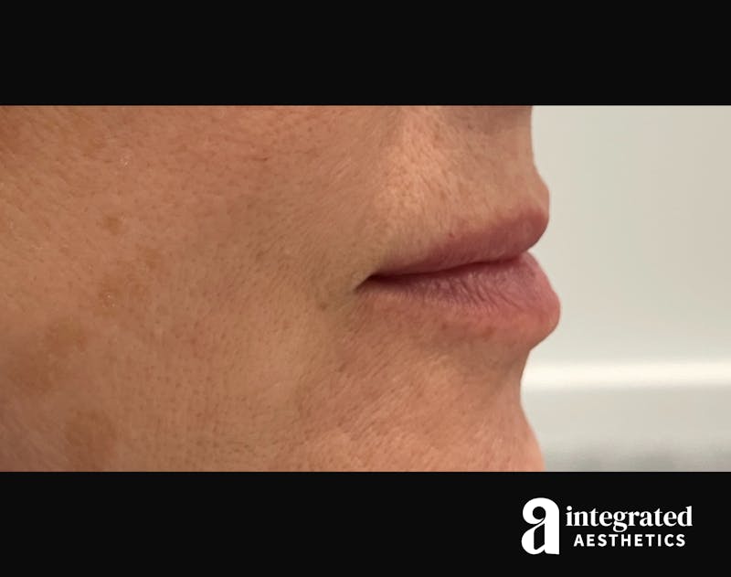 Dermal Fillers Before & After Gallery - Patient 133212672 - Image 5