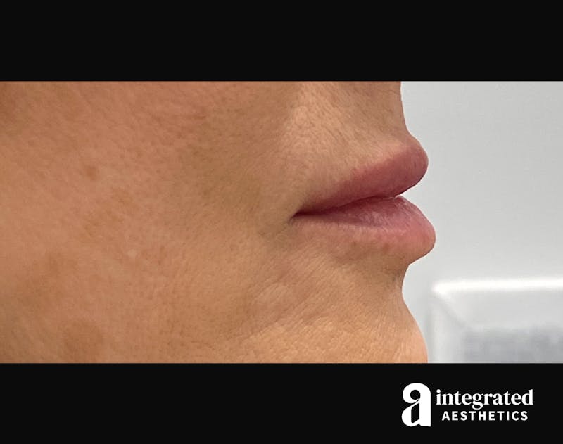 Dermal Fillers Before & After Gallery - Patient 133212672 - Image 6
