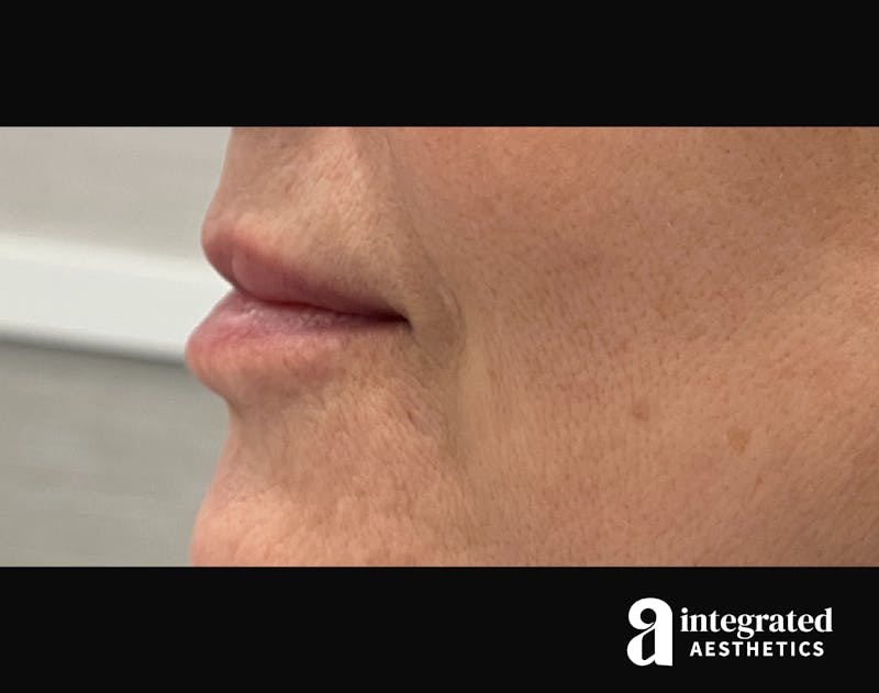 Dermal Fillers Before & After Gallery - Patient 133212672 - Image 7