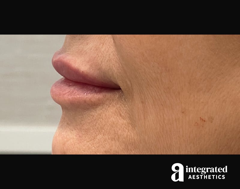 Dermal Fillers Before & After Gallery - Patient 133212672 - Image 8