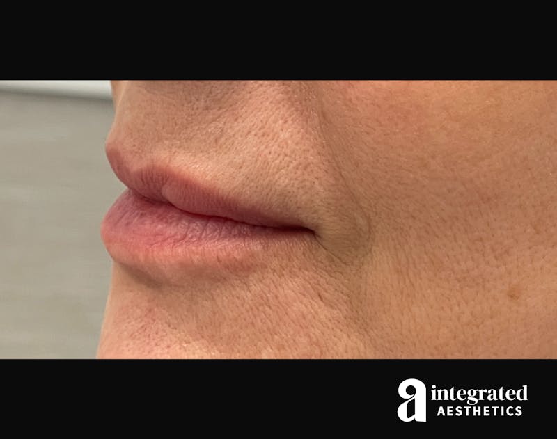 Dermal Fillers Before & After Gallery - Patient 133212672 - Image 9