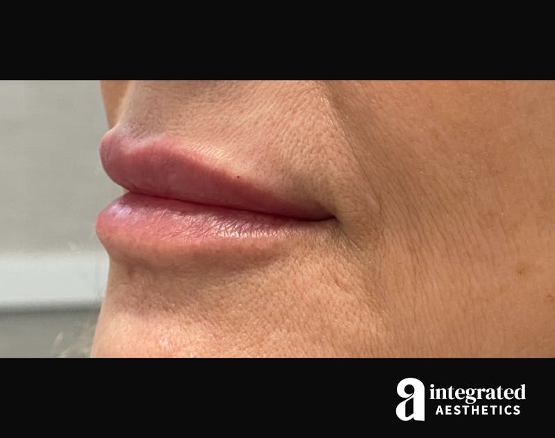 Dermal Fillers Before & After Gallery - Patient 133212672 - Image 10