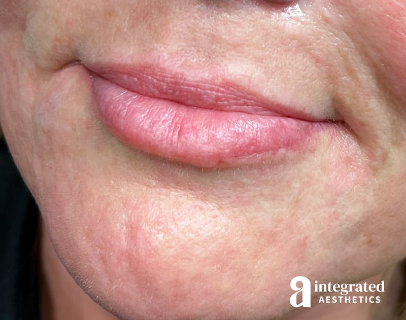 Lip Filler Before & After Gallery - Patient 157175668 - Image 1
