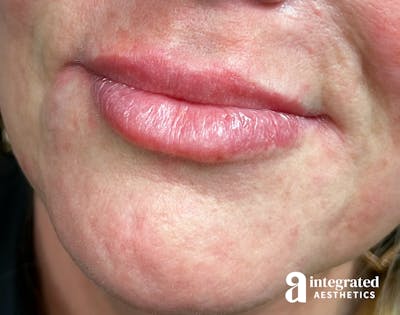 Dermal Fillers Before & After Gallery - Patient 133212673 - Image 2