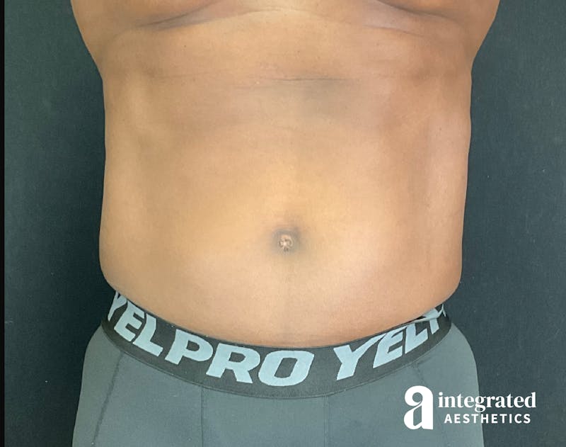 EmSculpt Before & After Gallery - Patient 133212683 - Image 2