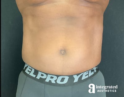 EmSculpt Before & After Gallery - Patient 133212683 - Image 2