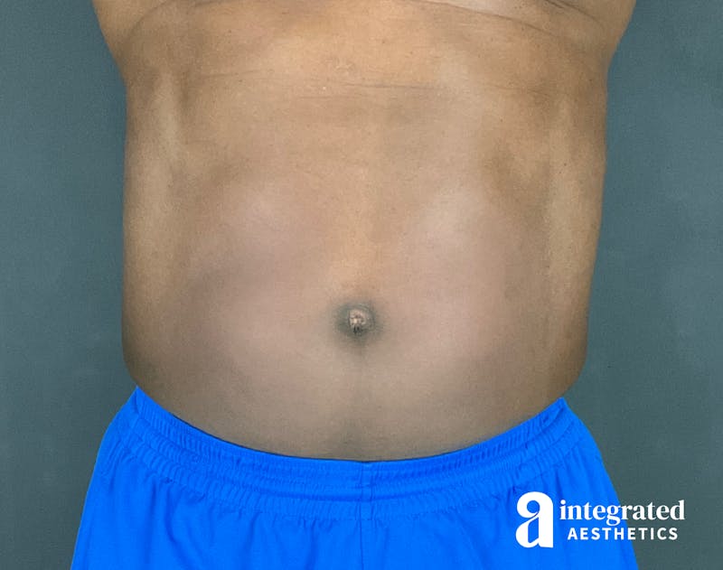 EmSculpt Before & After Gallery - Patient 133212683 - Image 1