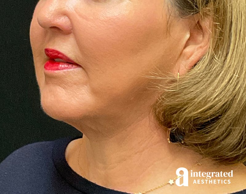 Facelift & Neck Lift Before & After Gallery - Patient 133212749 - Image 4
