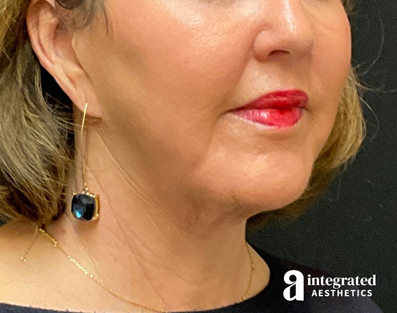 Facelift & Neck Lift Before & After Gallery - Patient 133212749 - Image 2