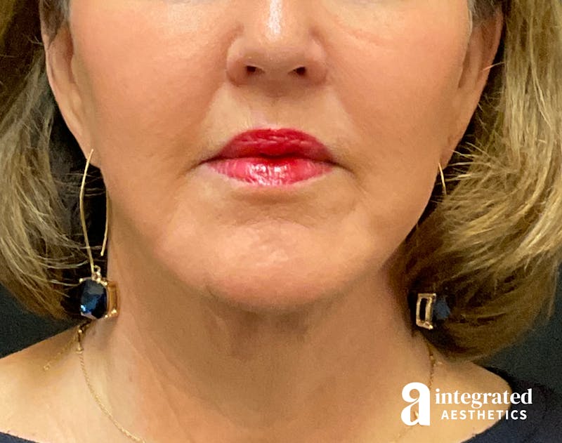 Facelift & Neck Lift Before & After Gallery - Patient 133212749 - Image 6