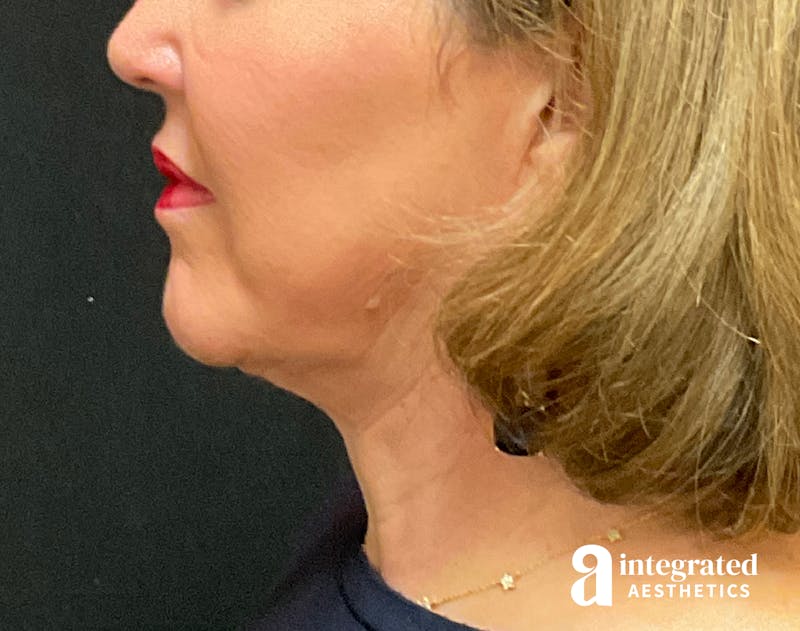 Facelift & Neck Lift Before & After Gallery - Patient 133212749 - Image 8