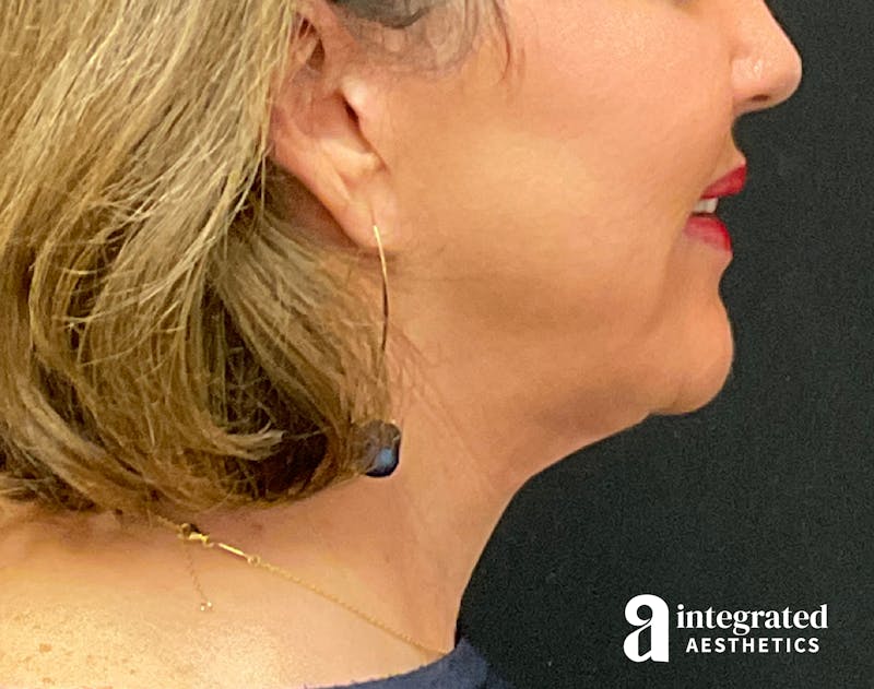 Facelift & Neck Lift Before & After Gallery - Patient 133212749 - Image 10