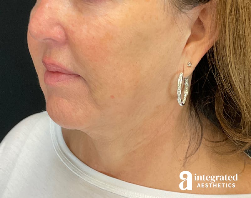 Facelift & Neck Lift Before & After Gallery - Patient 133212749 - Image 3