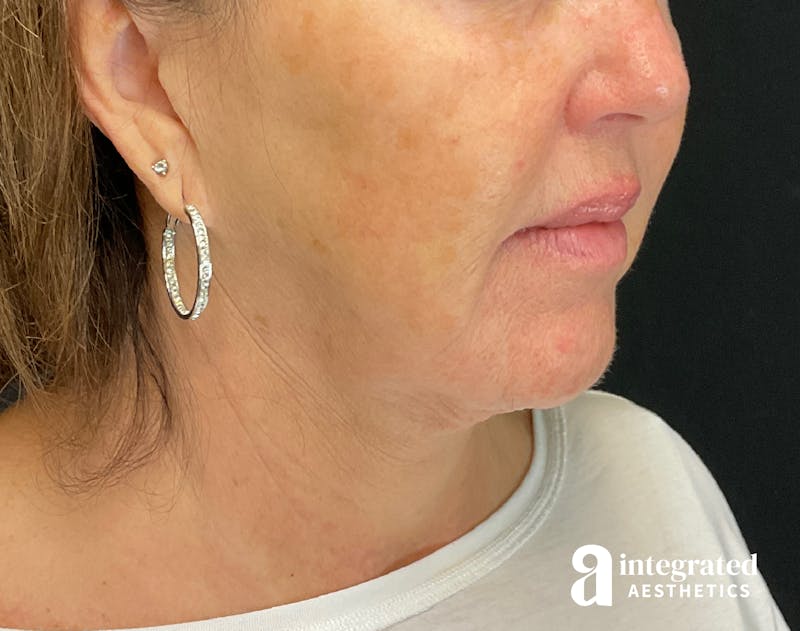Facelift & Neck Lift Before & After Gallery - Patient 133212749 - Image 1