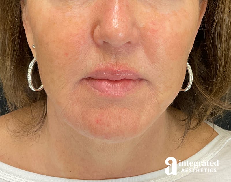 Facelift & Neck Lift Before & After Gallery - Patient 133212749 - Image 5