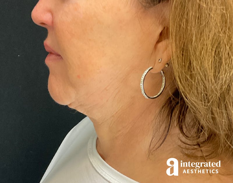 Facelift & Neck Lift Before & After Gallery - Patient 133212749 - Image 7