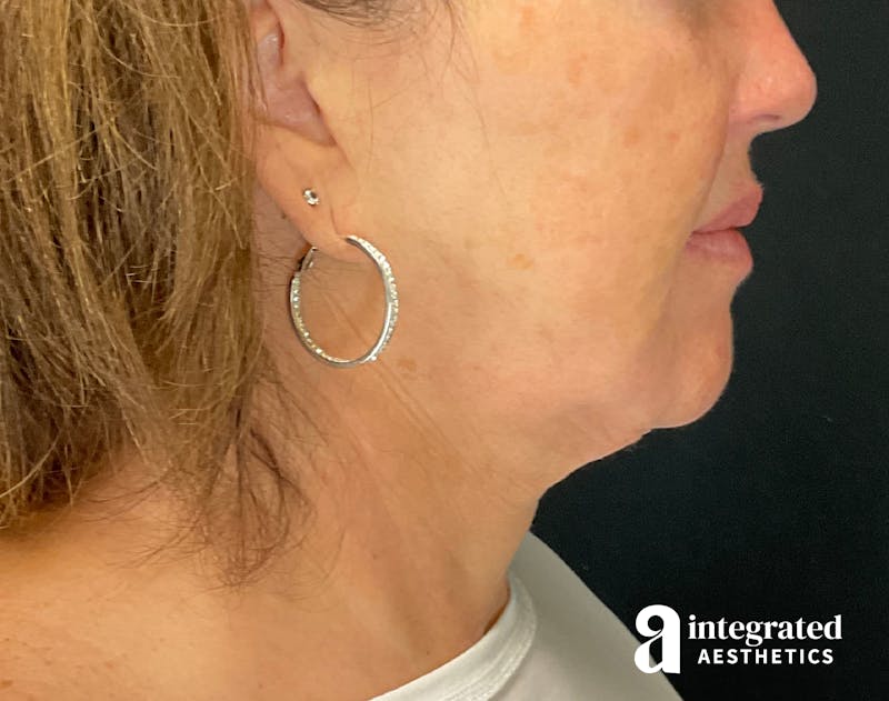 Facelift & Neck Lift Before & After Gallery - Patient 133212749 - Image 9