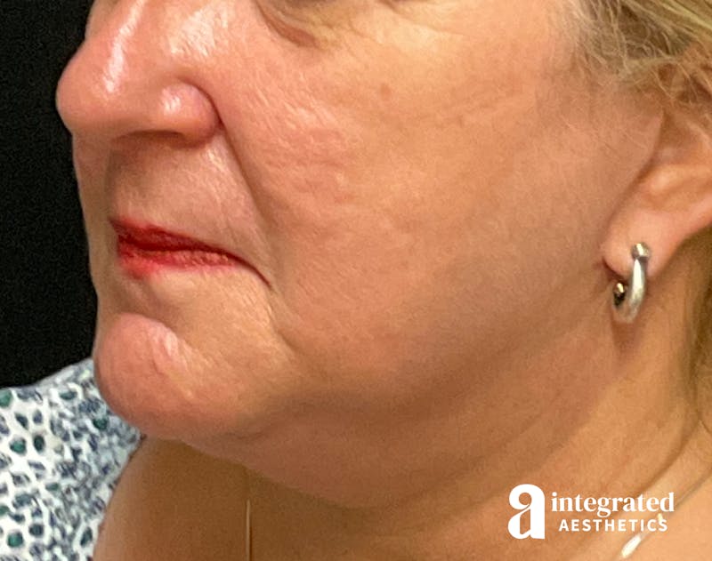 Facelift & Neck Lift Before & After Gallery - Patient 133212791 - Image 6