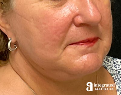 Facelift & Neck Lift Before & After Gallery - Patient 133212791 - Image 2