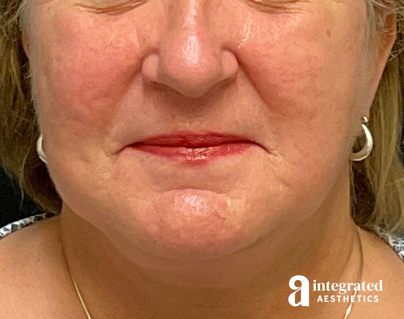 Facelift & Neck Lift Before & After Gallery - Patient 133212791 - Image 4