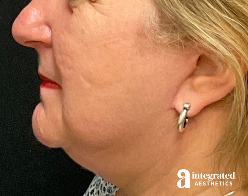 Facelift & Neck Lift Before & After Gallery - Patient 133212791 - Image 8